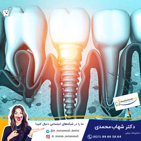 بهترین مارک ایمپلنت دندانی کدام است؟ - کلینیک دندانپزشکی دکتر شهاب محمدی